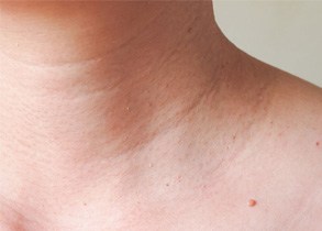 5 Things You Should Never Do to a Skin Tag