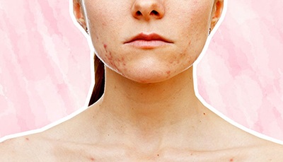 The Best Treatments For Getting Rid Of Stubborn Acne Scars