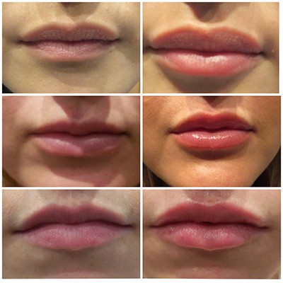 When Can I Use a Straw After Lip Filler?